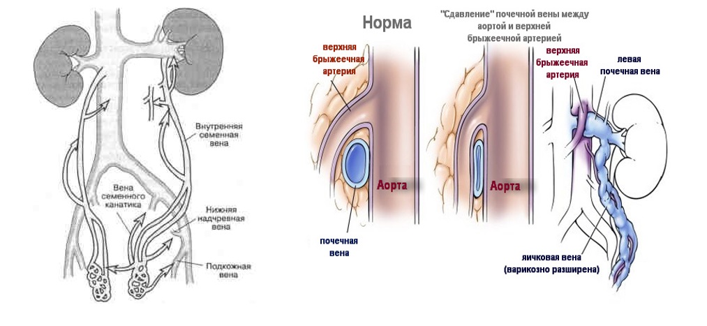 Хирургическое лечение варикозного расширения вен яичка и семенного канатика