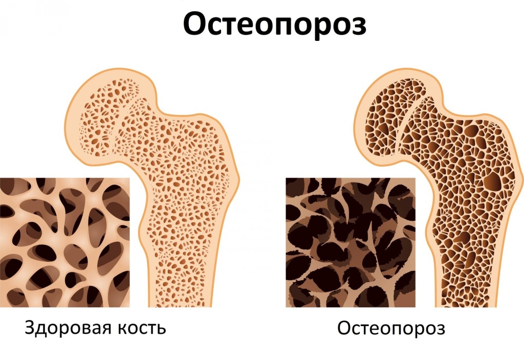 Остеопороз — причины, симптомы и лечение