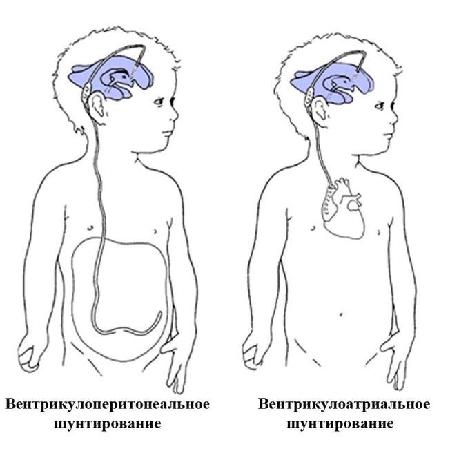 Лечение гидроцефалии головного мозга в Екатеринбурге - Новая Больница